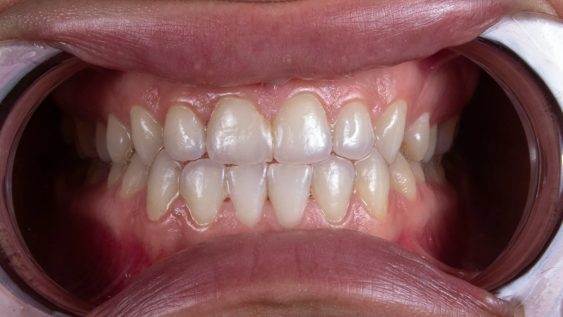 invisalign