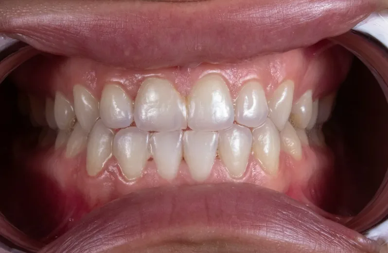 invisalign