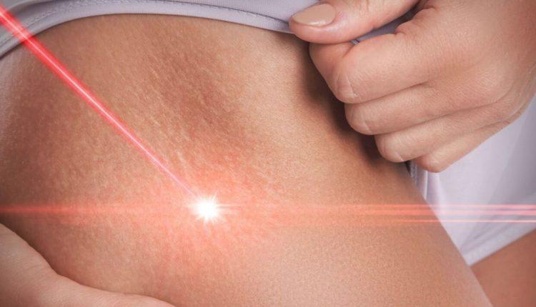 Terapi laser cara menghilangkan stretch mark