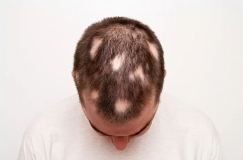 Apa itu Alopecia